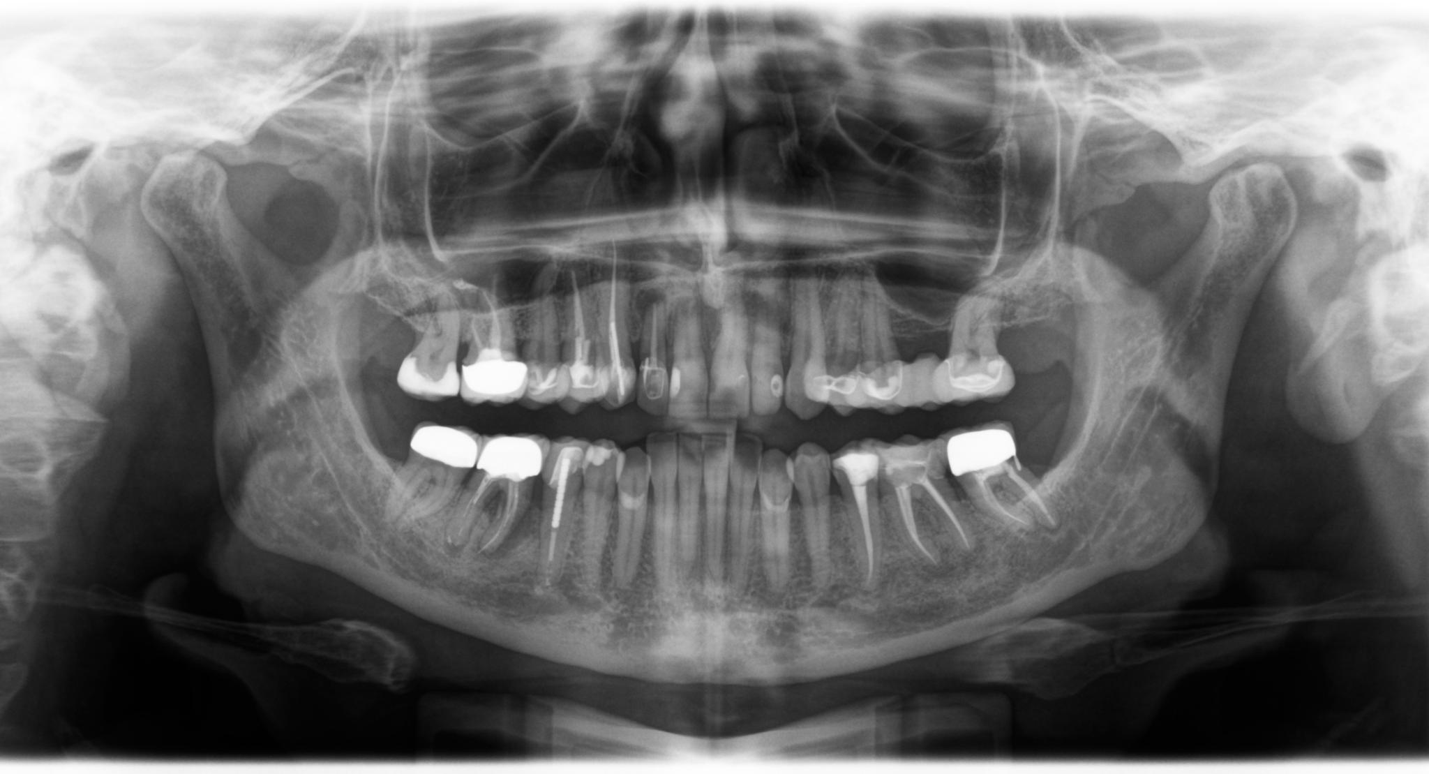 Стоматологический рентгеновский аппарат Orthophos S 3D Dentsply Sirona